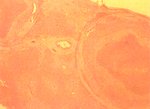 圖4：肝臟病灶形成膿瘍樣之化膿性炎症病變，周圍除纖維結締組織包被及嗜中性球浸潤外，尚有大量單核球浸潤。