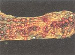 圖2：腸管粘膜面呈大小不一粟粒狀結節凸起。