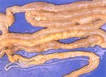 圖3：腸管擴張、腸壁變薄，腸腔內可見大量扁平條狀具片節之蟲體充塞。