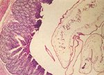 圖4：腸管絨毛上皮細胞融合，嗜酸性球浸潤，腔內可見蟲體。