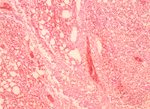 圖3：肺臟可見充出血及大量淋巴樣細胞增殖。