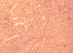 圖4：腎臟於腎小管間可見大量淋巴樣細胞增殖。