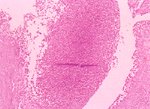 圖3：腓腹腱組織切片，大量炎症細胞浸潤於滑液膜下層，包括漿細胞、淋巴球、異嗜球及纖維素性滲出液。