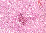 圖4：鏡下可流出脂肪空泡及局部壞死灶散播於肝小葉之各區域，其周區並見明顯出血灶。