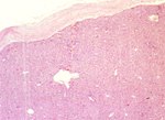 圖4：慢性病例肝臟表面有淋巴球及纖維組織增生浸潤。