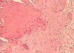 圖3：切片下可見表皮層棘狀細胞增生且有大量角質層附著於外，更高倍可見不具染色性之黴菌菌絲。