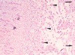 圖2：在壞死區可見巨噬細胞（箭）、結締組織（箭頭）增生及大量菌絲和 PAS 染色呈陽性反應