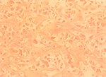 圖3：肝臟肝竇狀隙內有粉紅色晶質樣類澱粉樣物質蓄積，而肝索斷離肝細胞變性。