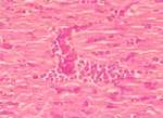 圖4：心肌纖維呈波浪狀、橫紋消失、顆粒化，其間有紅血球、異嗜球、單核細胞浸潤及水腫液蓄積。