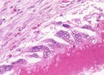 圖4：潰瘍灶周區可見大量異物巨細胞之浸潤，