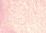 圖2：小腦白質可見嚴重脫髓鞘現象。