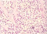 圖2：肉瘤腫瘤細胞鋪成一面板樣，浸潤於子宮壁平滑肌間。