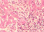 圖3：肉瘤腫瘤細胞浸潤於肝索間，細胞核呈橢圓至紡錘不整形；細胞質較嗜伊紅性，細胞周邊不明，腫瘤細胞間混有一些多形核細胞為本腫瘤的特徵。