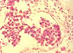 圖4：侵犯腦膜血管內之組織細胞內有腫瘤細胞栓(neoplastic embolus)；腫瘤細胞質與核等構造比前二圖清晰可見 。 