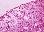 圖2：胸膜下方肺泡出現大量淡染，嗜伊紅性細胞；細胞質呈顆粒，泡沫狀。