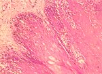 圖4：表皮釘基部可見基底細胞完整。增生細胞以棘狀細胞為主。