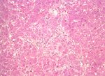 圖3：處理組大鼠肝臟膽管上皮增生明顯。