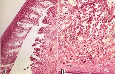 圖 5A：口蹄疫患豬蹄冠部組織切片：上皮細胞增生、出血。圖 5B：左圖之高倍相，增生之棘狀上皮細胞呈氣球樣變性。