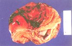 圖2：胃粘膜呈瀰漫性出血灶。