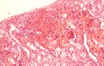 圖3：腎小管上皮細胞腫脹變性，腎臟皮質部間質組織有血管外紅血球聚集（出血），絲球體之微血管叢及鮑氏囊腔周圍可見嗜伊紅性，均質樣血栓形成。