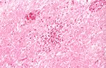 圖4：非化膿性腦炎：小神經膠細胞聚集及淋巴圍管等現象。