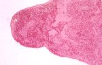 圖2：脾臟在顯微鏡下，呈現梗塞區。