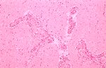 圖4：非化膿性腦炎；可見淋巴球圍管及血管內皮細胞增生等病變。