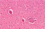 圖3：大腦實質可見血管有淋巴球性圍管及血管內皮細胞增生。