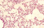 圖2：肺水腫，肺泡腔內可見粉紅色滲出液，肺泡上皮細胞輕度增生。