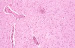 圖3：SPF 豬感染野外豬瘟病毒第 12 天，腦組織切片可見顯著非化膿性腦炎病變，腦實質有數個 glial nodules，血管內皮細胞增生及淋巴球圍管現象。