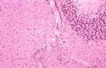 圖3：非化膿性腦炎：腦實質可見圖淋巴球圍管，血管內皮細胞增生，小神經膠細胞增生及噬神經現象等病變