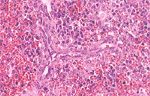 圖4：脾：局部梗塞，血管內皮細胞增生，脾小結周圍成熟淋巴球減少，改由網狀內皮細胞所取代。