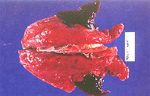 圖2：肺心葉、尖葉呈硬實暗紅肺炎病灶。