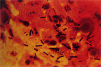 圖 3:小腸前段直接塗抹可見到大量革蘭氏陽性肥胖桿菌。