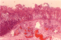 圖 4:低倍下腸管絨毛呈瀰漫性淺層凝層凝固樣壞死,粘膜層被壞死偽膜取代,粘膜下層有肌層有明顯的氣腫,靜脈鬱血並有血栓形成。