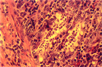 圖4：低倍下於腸管腺窩內可見到大量滴蟲蟲體。