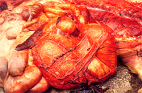 圖3: 胃大網膜之血管怒張呈螺旋狀。