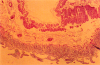 圖4: 胃粘膜層及肌肉層充血,肌肉層血腔內可見玻璃樣血栓形成。