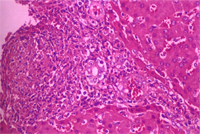 圖3：肝臟實質組織內可見局灶性壞死。