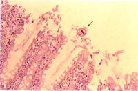 圖2：大腸粘膜層之杯狀細胞增生，可見大腸纖毛蟲蟲體。