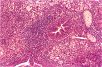 圖4：肺臟支氣管周圍淋巴瀘泡增生，並可見嗜伊紅性滲出物聚集在肺泡腔。