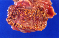 圖1：大腸黏膜面可見黃白色的鈕扣狀潰瘍灶。 