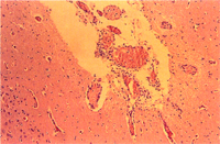 圖2：大腦呈輕微非化膿炎腦膜腦炎，腦膜有淋巴球浸潤。