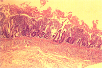 圖5：大腸黏膜面可見壞死脫落的腸粘模上皮細胞及少數的大腸纖毛蟲。 