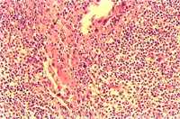 圖6：扁桃線可見局部壞死灶，在壞死灶內並可見嗜酸性核內包涵體(如箭頭)。