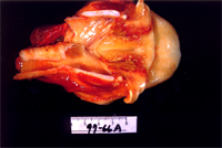 圖3：甲狀軟骨表面局部黃白色偽膜附著。