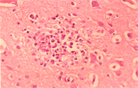圖 5：大腦非化膿性腦炎，及glial nodule於腦 實質。 H & E stain,400X 