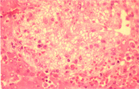 圖 6：肝多發局部凝固性壞死。 H & E stain,400X 