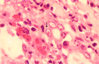 圖7：甲狀軟骨黏膜下散發局部凝固性壞死， 周圍可見嗜酸性核內包涵體。(箭頭) H & E stain,400X 