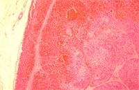 圖8：淋巴結周邊出血且淋巴球大量減少。 H & E stain,40X 